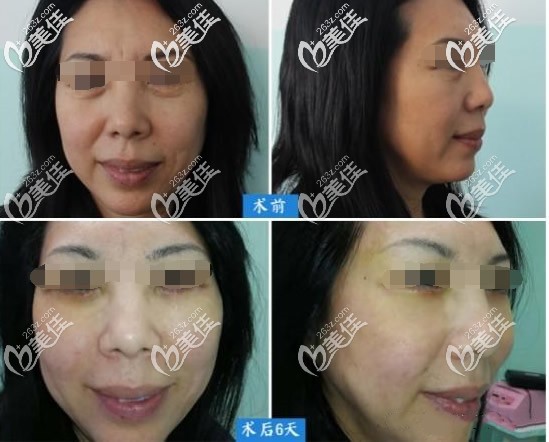 真人外切眼袋加面中部提升前后对比照片 真人外切眼袋加面中部提升前后对比照片