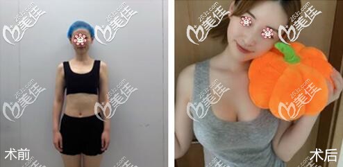 杭州隆胸好的医院格莱美案例