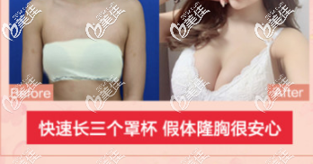 北京艺星医疗美容医院假体隆胸案例