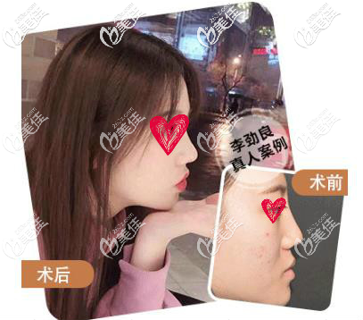 李劲良医生鼻修复案例 李劲良医生鼻修复案例