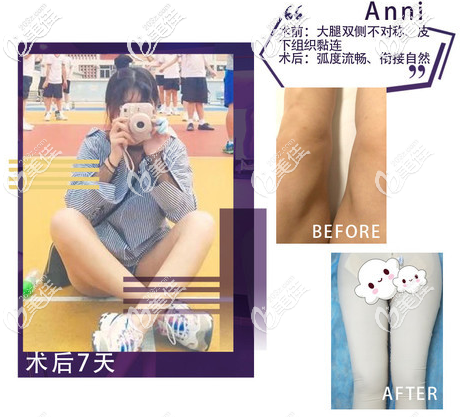 北京雅靓多维立体吸脂案例