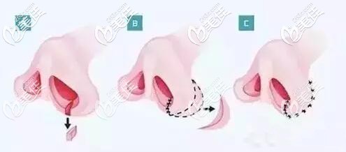 鼻翼切除术原理 鼻翼切除术原理