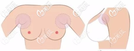 副乳长的部位示意图 副乳长的部位示意图
