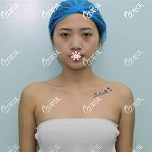 我术前的胸 我术前的胸