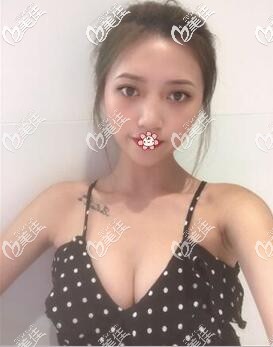 我在泰国艺术整形做完隆胸手术20天了 我在泰国艺术整形做完隆胸手术20天了