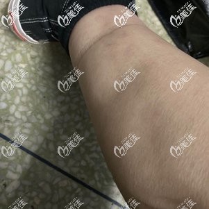 大小腿吸脂前的腿部赘肉 大小腿吸脂前的腿部赘肉