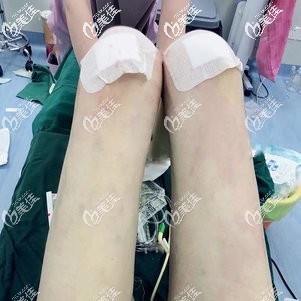 威塑吸脂瘦腿术后即刻 威塑吸脂瘦腿术后即刻