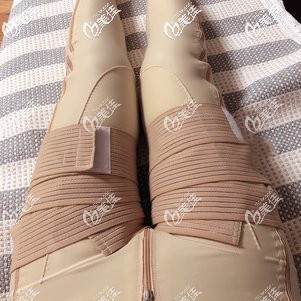 腿部抽脂术后7天肿胀轻微 腿部抽脂术后7天肿胀轻微