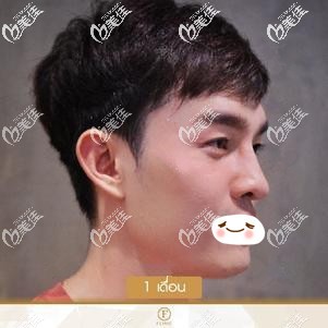 都说我在泰国花17000元做的进口硅胶隆鼻手术很成功 大家来看这直鼻效果如何