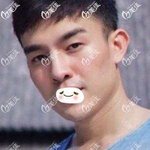 术前鼻子塌平 术前鼻子塌平