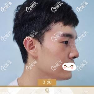 做硅胶隆鼻术后3天鼻子微肿胀 做硅胶隆鼻术后3天鼻子微肿胀