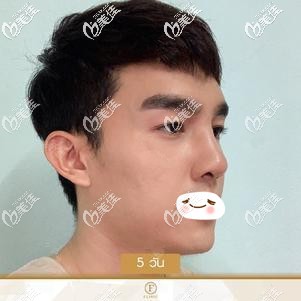 进口硅胶隆鼻术后5天拆线后鼻子高挺 进口硅胶隆鼻术后5天拆线后鼻子高挺