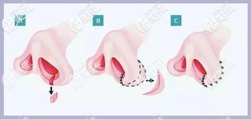 鼻翼外切原理 鼻翼外切原理