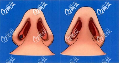 鼻孔内切原理 鼻孔内切原理