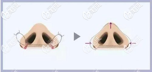 鼻孔聚拢原理 鼻孔聚拢原理