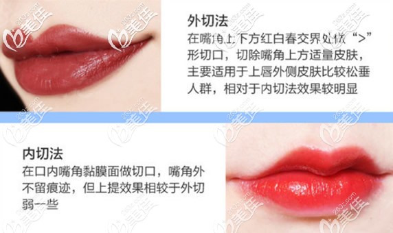 内切和外切嘴角上扬术区别 内切和外切嘴角上扬术区别