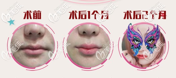 嘴角上扬手术2个月效果 嘴角上扬手术2个月效果
