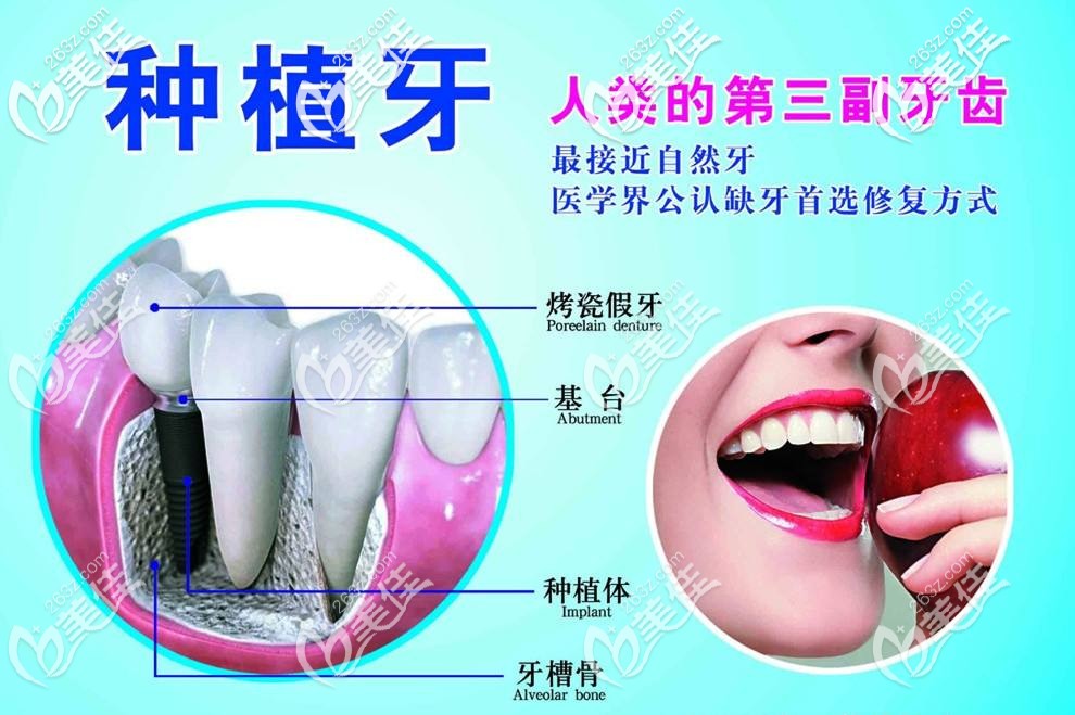 种植牙是人类的第三幅牙齿 种植牙是人类的第三幅牙齿