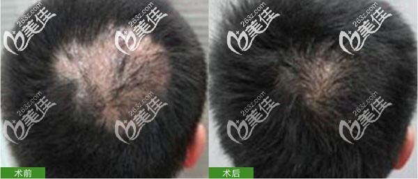 长沙岱高头部烫伤疤痕植发 长沙岱高头部烫伤疤痕植发