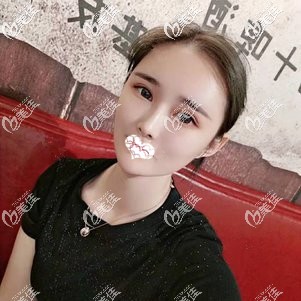 觉得做自体脂肪填充苹果肌会后悔的小姐姐可以看下我丰脸前后效果对比图