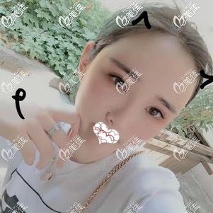 术后15天面部线条更加流畅柔和 术后15天面部线条更加流畅柔和