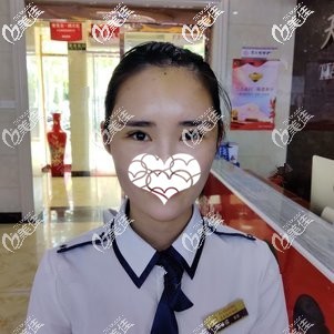 自体脂肪填充苹果肌术后5天全脸微肿 自体脂肪填充苹果肌术后5天全脸微肿