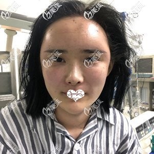 刚做完脂肪填充面部手术后肿胀感较强 刚做完脂肪填充面部手术后肿胀感较强