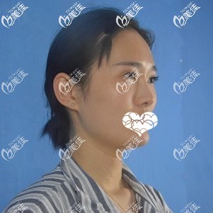 术前面部凹陷 术前面部凹陷