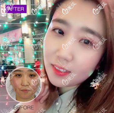 遵义韩美能祛痘吗 遵义韩美能祛痘吗