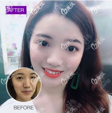 遵义韩美自体脂肪全脸填充 遵义韩美自体脂肪全脸填充