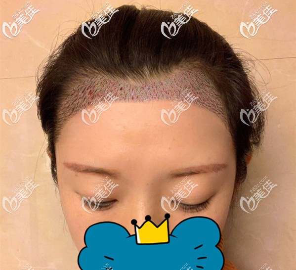 发际线种植后即刻效果