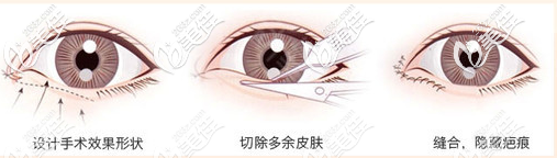 汕头爱都沪美人双眼皮手术演示图