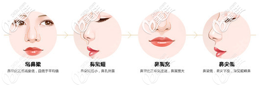 汕头ido整形医院隆鼻手术 汕头ido整形医院隆鼻手术