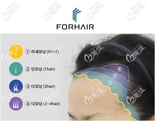 发际线种植分为四个步骤种植