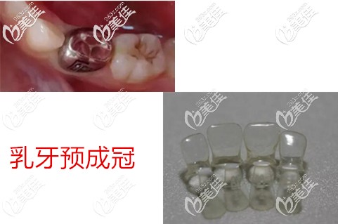 乳牙金属和透明预成冠