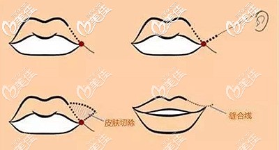 嘴角上扬手术的原理
