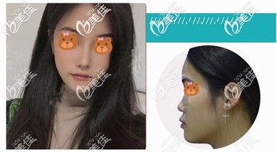 做耳软骨隆鼻后的效果对比 做耳软骨隆鼻后的效果对比