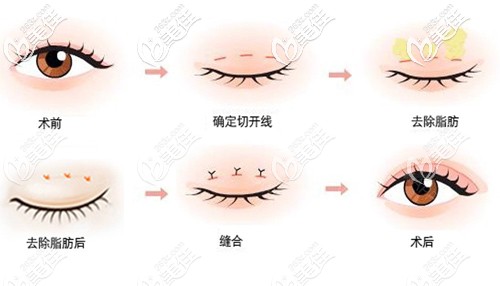 刘医生做双眼皮手术原理示意图