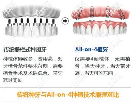 传统种牙与ALL-ON-4种植技术对比 传统种牙与ALL-ON-4种植技术对比
