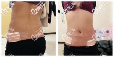 腰腹环吸后4天出院后的恢复效果