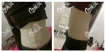 腰腹环吸后一周