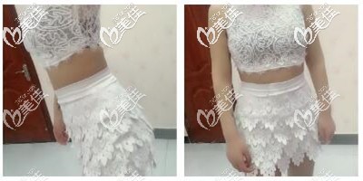 腰腹抽脂后一个月恢复