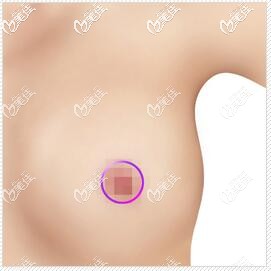 环状乳晕切口法 环状乳晕切口法