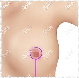 标准的乳房缩小手术方法 标准的乳房缩小手术方法