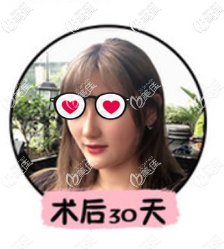 鼻综合整形1个月恢复图