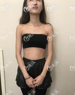 术前我的胸就是这么平 术前我的胸就是这么平