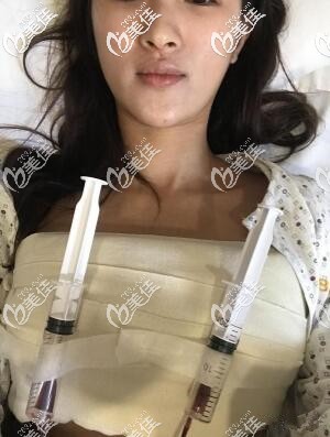 我在泰国咖蒙医院做完假体胸第二天