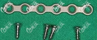 磨骨中的“小零件”钛钉图片 磨骨中的“小零件”钛钉图片