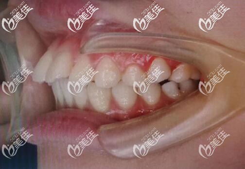 门牙前突矫正前的照片 门牙前突矫正前的照片