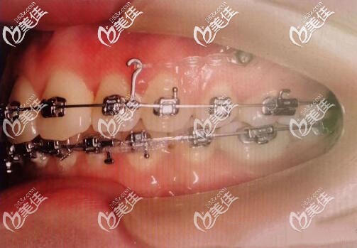 戴进口金属自锁托槽矫正龅牙 戴进口金属自锁托槽矫正龅牙